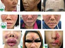 Tàn phá dung nhan vì tiêm, cấy chất trẻ hóa da