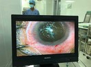 Nguy cơ mù mắt vì tia laser điều trị thẩm mỹ da