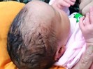 Mổ đẻ, bác sĩ đụng dao làm rách da đầu bé sơ sinh