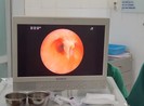 Ho suốt ba năm trời mới phát hiện bị mắc xương cá