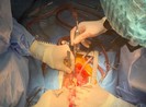 Cứu sống bệnh nhân bị u tim lớn tuổi nhất miền Tây