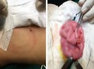 Bé bốn tuổi vỡ ruột nguy kịch do anh ném lon bia vào bụng