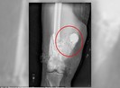 Nhờ cảnh sát lấy pháo hoa trong đùi bệnh nhân