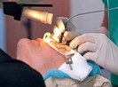 Có nên phẫu thuật chữa cận thị?