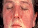 Lupus ban đỏ nguy hiểm như thế nào?