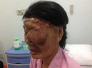 Cứu bệnh nhân có 20 mạch máu dị dạng
