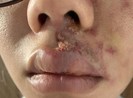 Mặt sưng phù, mưng mủ sau tiêm filler làm đầy rãnh má
