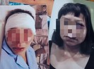 Khởi tố vụ án chồng đánh vợ dã man ở Quảng Ninh