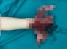 Cậu bé 16 tuổi nát bét tay vì vừa dùng điện thoại vừa sạc