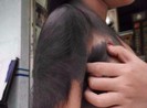 Cơ hội chữa bệnh miễn phí cho bé gái 'người sói'