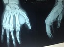 Nối thành công đốt ngón tay cái bị xích xe cắt đứt