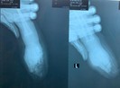 Người lớn sơ sẩy vài giây, bốn ngón tay bé một tuổi bị đứt lìa