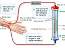 Quá trình chạy thận diễn ra như thế nào?