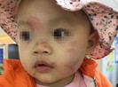 Bé gái 14 tháng tuổi bầm tím mặt sau ngày đi học đầu tiên