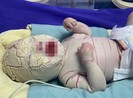 Quảng Ninh: Bé trai sinh non bị bệnh hiếm, vảy trắng toàn thân