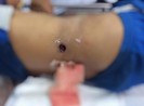 Đeo súng đi săn, súng cướp cò bắn thủng bụng nguy kịch