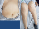 Báo động tình trạng lạm dụng corticoid do mua thuốc “dễ dãi“