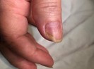 Người phụ nữ 5 năm treo tay lên đầu giường để ngủ