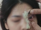 Cô gái 21 tuổi mù mắt sau khi tiêm filler nâng mũi