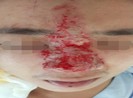 Thêm 1 người có nguy cơ mù mắt sau khi tiêm filler nâng mũi
