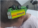 Cấp cứu cho bé trai bị xe đồ chơi cắm vào đầu