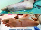 2 bệnh viện chạy đua cứu sống bàn chân bé gái