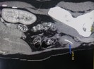 Người phụ nữ bị xương cá dài 3 cm đâm thủng ruột