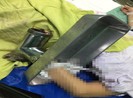 Người phụ nữ 'bồng' máy xay thịt vào bệnh viện cấp cứu