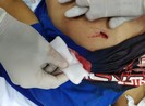 Bí ẩn người phụ nữ đưa nạn nhân bị đâm thấu ngực vào viện