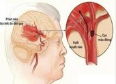 Bác sĩ Việt Nam cứu nhiều người nước ngoài bị đột quỵ và xuất huyết não ảnh 2 Phân loại các dạng đột quỵ