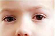 Bệnh đau mắt đỏ có thể gây biến chứng nặng ở người có sức đề kháng yếu.