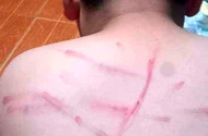 Thanh Hóa: Cô giáo đánh bầm tím lưng học sinh vì không làm bài tập 