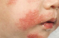 Cảnh báo dị ứng đạm sữa bò