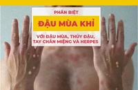 Phân biệt đậu mùa khỉ với đậu mùa, thủy đậu, tay chân miệng và herpes