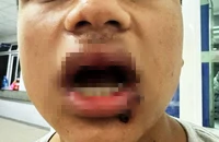 Nam sinh lớp 9 bị nhóm người đánh gãy 4 cái răng trên bờ biển