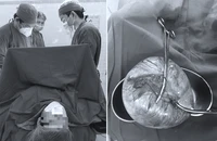 Mổ lấy khối u ‘khủng’ gần 2 kg cứu thai phụ và cháu bé