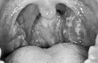 Coi chừng viêm họng có thể dẫn đến bệnh thấp tim