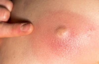 5 sai lầm thường gặp khi trị mụn nhọt và cách xử trí