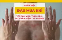 Phân biệt đậu mùa khỉ với đậu mùa, thủy đậu, tay chân miệng và herpes