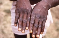 Một bệnh nhân bị mắc bệnh đậu mùa khỉ ở Nigeria.