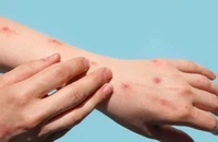 Nhiều người nhiễm HIV bị dính thêm đậu mùa khỉ