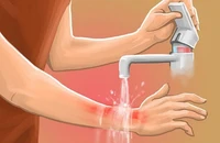 Ngâm con trong thùng nước lạnh để chữa bỏng khiến trẻ bị sốc nhiệt