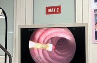 Kim diệt tủy răng lọt vào ruột non bé 8 tuổi