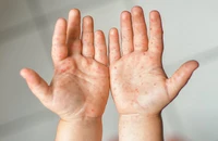Hà Nội ghi nhận 6 ổ dịch tay chân miệng trong một tuần