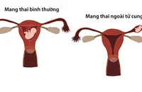 Có thai nhưng không đi khám, người phụ nữ suýt tử vong vì thai ngoài tử cung