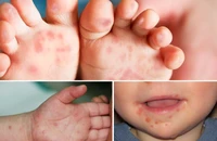 Bộ Y tế ra công văn hỏa tốc trước diễn biến phức tạp của bệnh tay chân miệng