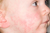 Tại sao nhiều trẻ tiêm đủ 2 mũi vaccine sởi vẫn mắc bệnh?