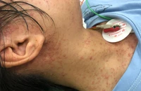 Cô gái suýt tử vong do mắc thủy đậu