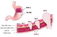 Bác sĩ khuyến cáo việc bệnh nhân uống thuốc nam làm tan khối u