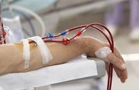 Đau đầu kéo dài, đi khám phát hiện suy thận giai đoạn cuối